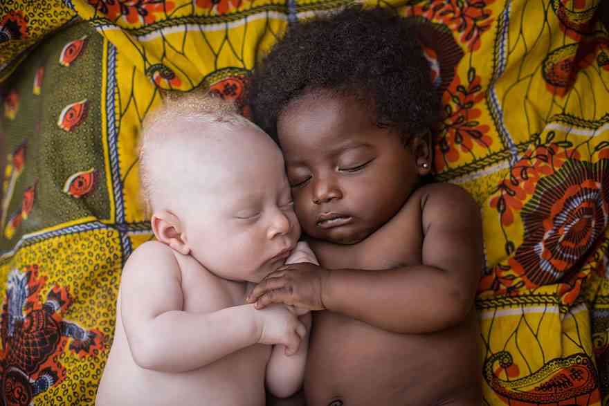 Black Baby Next To Albino Baby
