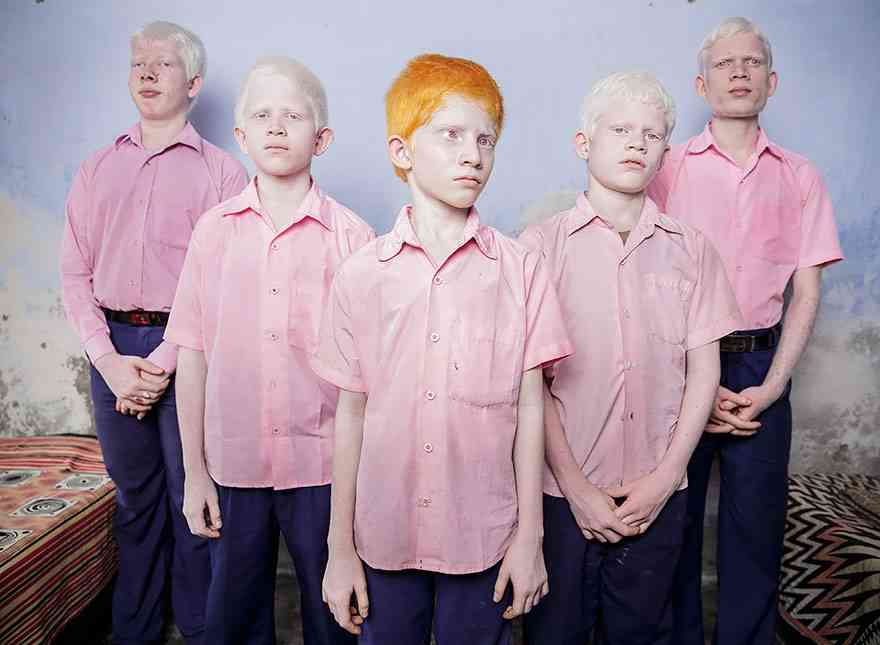 Blind Albino Students Pose In The Dormitory Of A School In Vivekanda, India