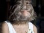 Girl With Hypertrichosis. In The Middle Ages, People Suffering From This Syndrome Were Considered Werewolves