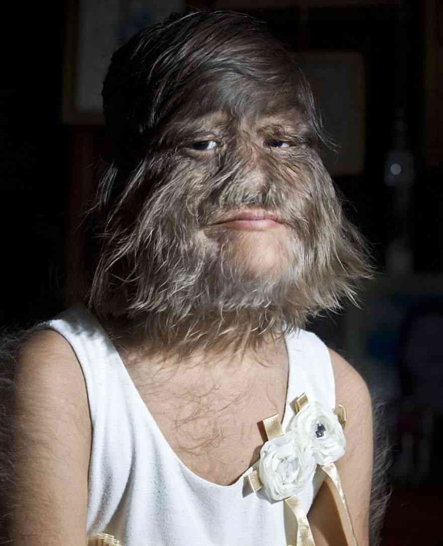 Girl With Hypertrichosis. In The Middle Ages, People Suffering From This Syndrome Were Considered Werewolves