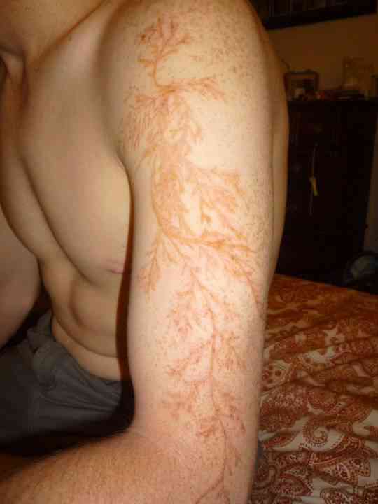 What The Skin Looks Like After Being Struck By Lightning